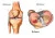 Een schematische weergave van een meniscus scheur