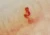 Telangiectasia in the nail bed