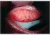 Telangiectases in the eyes in HHT patients