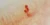 Telangiectasia in the nail bed