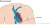 Draadloze pacemaker (S-ICD / EV-ICD)