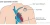 Biventriculaire ICD