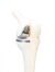 Modelfoto van een halve knieprothese in een kniegewricht