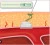 Angioseal